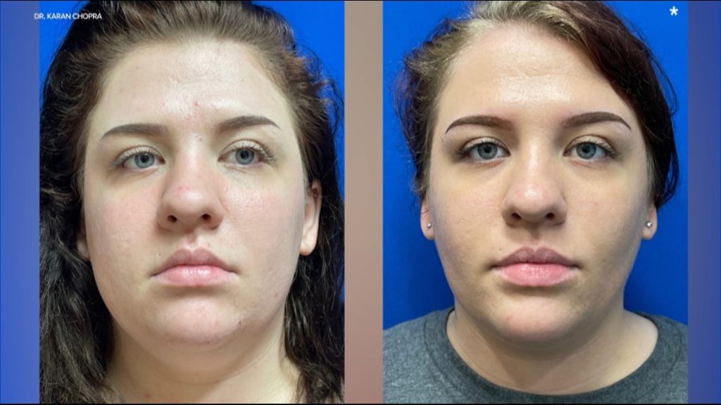 Shape Your Face with Buccal Fat Removal: A Popular Procedure in NYC