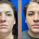 Shape Your Face with Buccal Fat Removal: A Popular Procedure in NYC