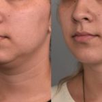 Achieve a Defined Jawline with Chin Liposuction in NYC