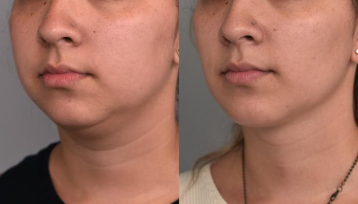 Achieve a Defined Jawline with Chin Liposuction in NYC