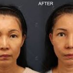 Transform Your Look with Ethnic Rhinoplasty in NYC