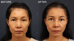 Transform Your Look with Ethnic Rhinoplasty in NYC