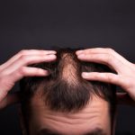 What Does Hair Transplant Cost: The Truth About Pricing and Quality